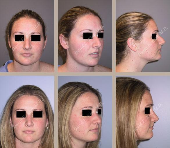 Beverly Hills Plastic Surgery gallery image 8