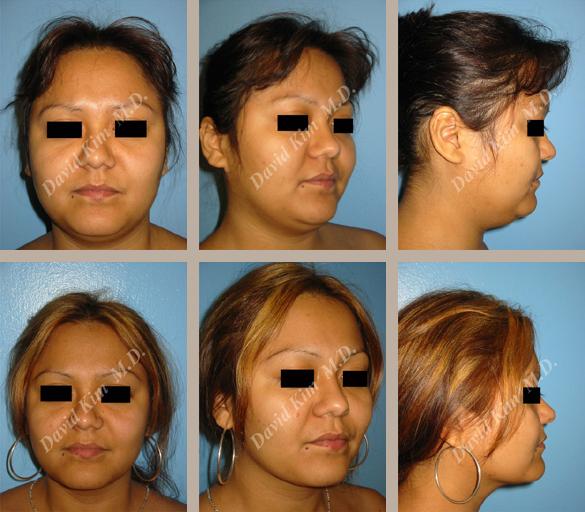 Beverly Hills Plastic Surgery gallery image 16