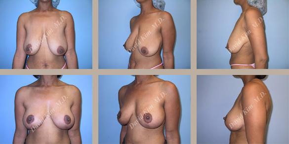 Beverly Hills Plastic Surgery gallery image 25