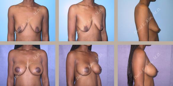 Beverly Hills Plastic Surgery gallery image 33