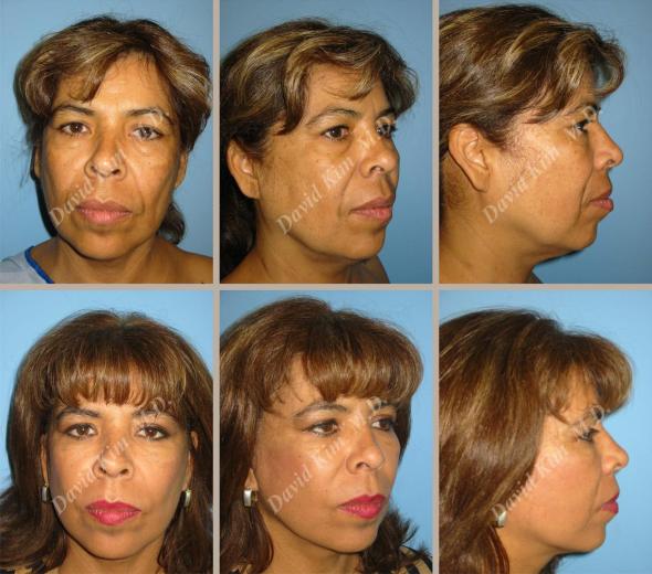 Beverly Hills Plastic Surgery gallery image 41