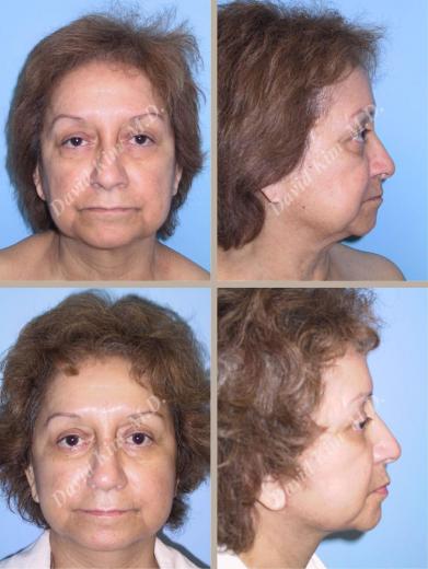 Beverly Hills Plastic Surgery gallery image 42