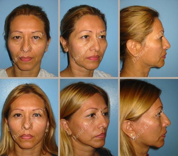 Beverly Hills Plastic Surgery gallery image 43