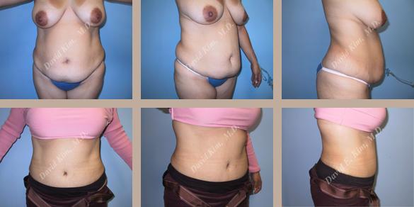 Beverly Hills Plastic Surgery gallery image 78