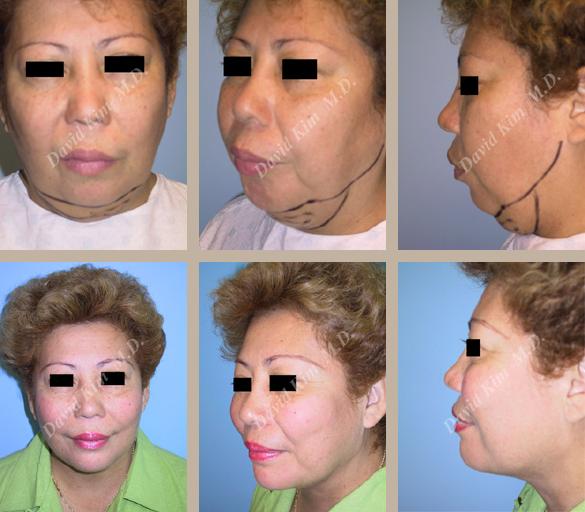 Beverly Hills Plastic Surgery gallery image 90
