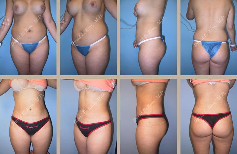 Beverly Hills Plastic Surgery gallery image 96