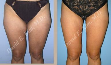 Beverly Hills Plastic Surgery gallery image 101