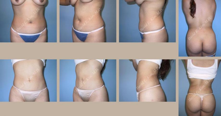 Beverly Hills Plastic Surgery gallery image 104