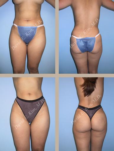Beverly Hills Plastic Surgery gallery image 116