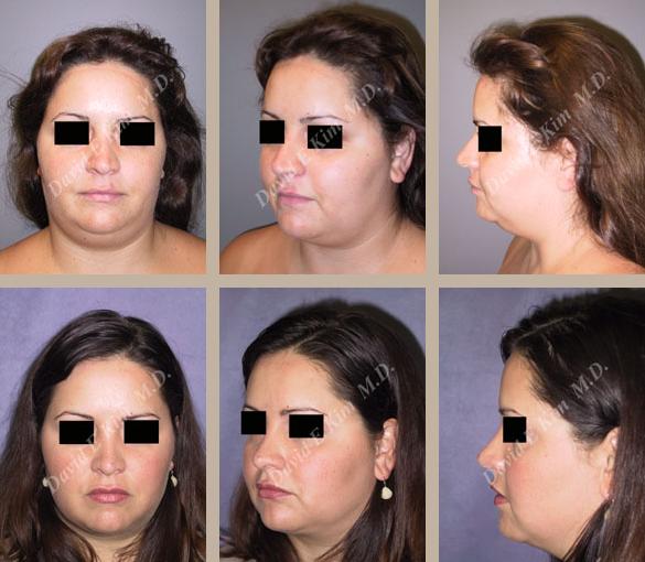 Beverly Hills Plastic Surgery gallery image 120