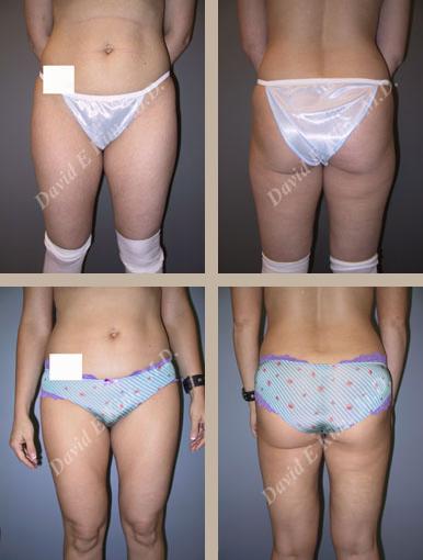 Beverly Hills Plastic Surgery gallery image 123