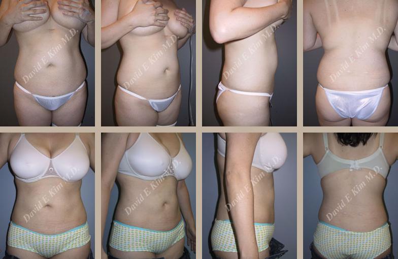 Beverly Hills Plastic Surgery gallery image 130