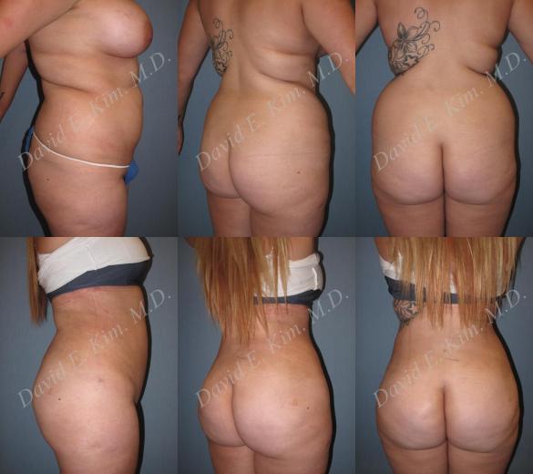 Beverly Hills Plastic Surgery gallery image 174