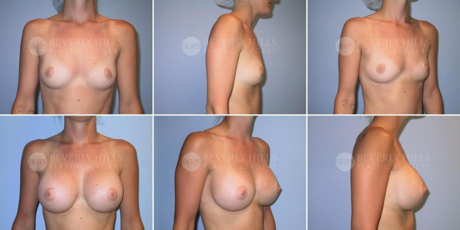 Beverly Hills Plastic Surgery gallery image 212