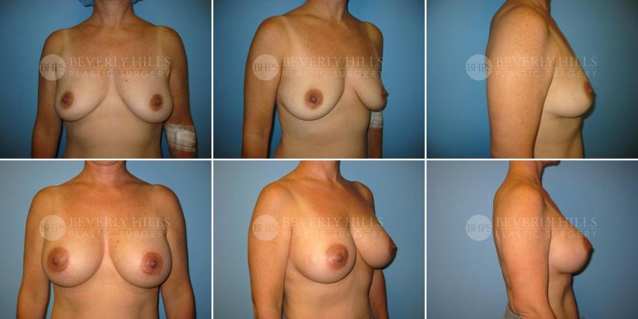 Beverly Hills Plastic Surgery gallery image 213