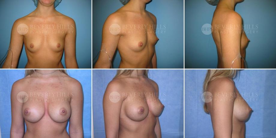 Beverly Hills Plastic Surgery gallery image 214