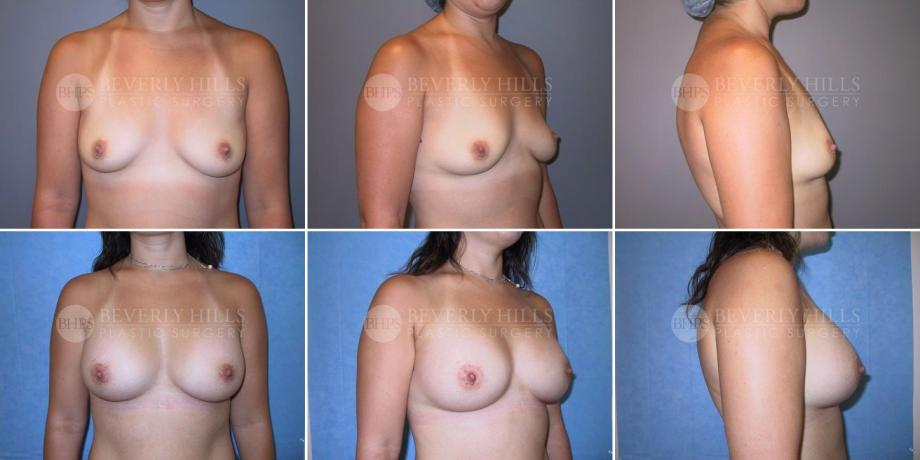 Beverly Hills Plastic Surgery gallery image 216