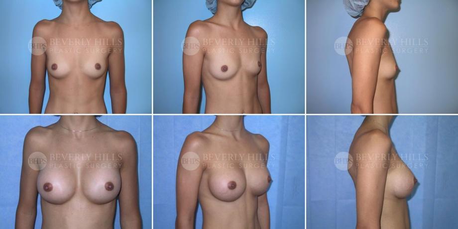 Beverly Hills Plastic Surgery gallery image 217