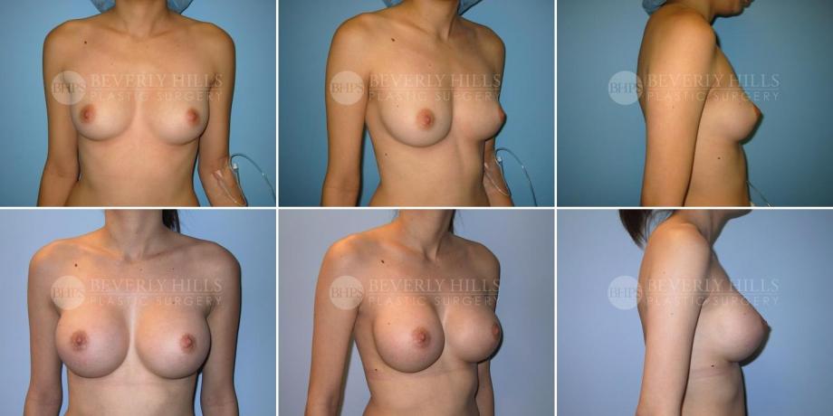 Beverly Hills Plastic Surgery gallery image 218