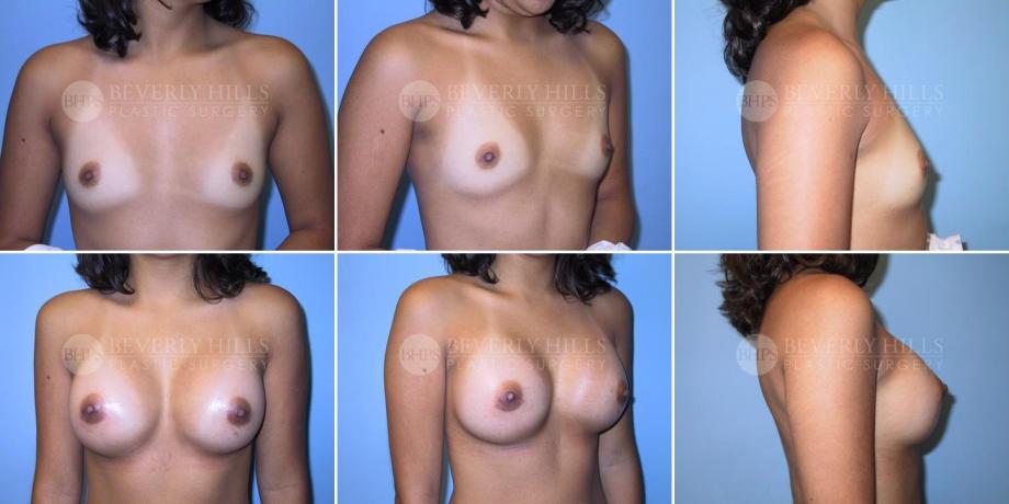 Beverly Hills Plastic Surgery gallery image 221