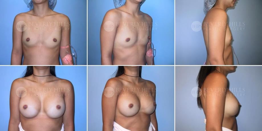 Beverly Hills Plastic Surgery gallery image 222
