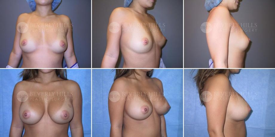 Beverly Hills Plastic Surgery gallery image 223
