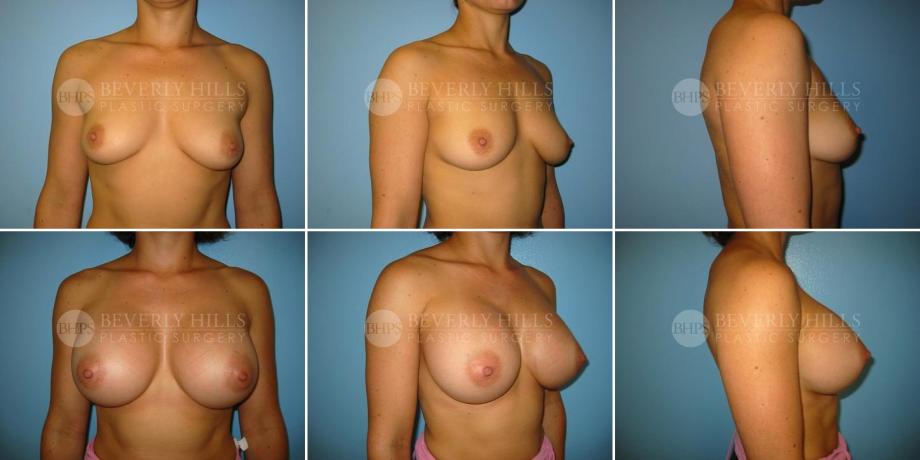 Beverly Hills Plastic Surgery gallery image 224