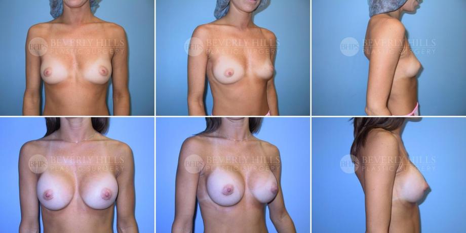 Beverly Hills Plastic Surgery gallery image 225