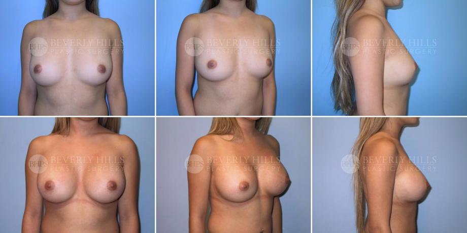 Beverly Hills Plastic Surgery gallery image 228