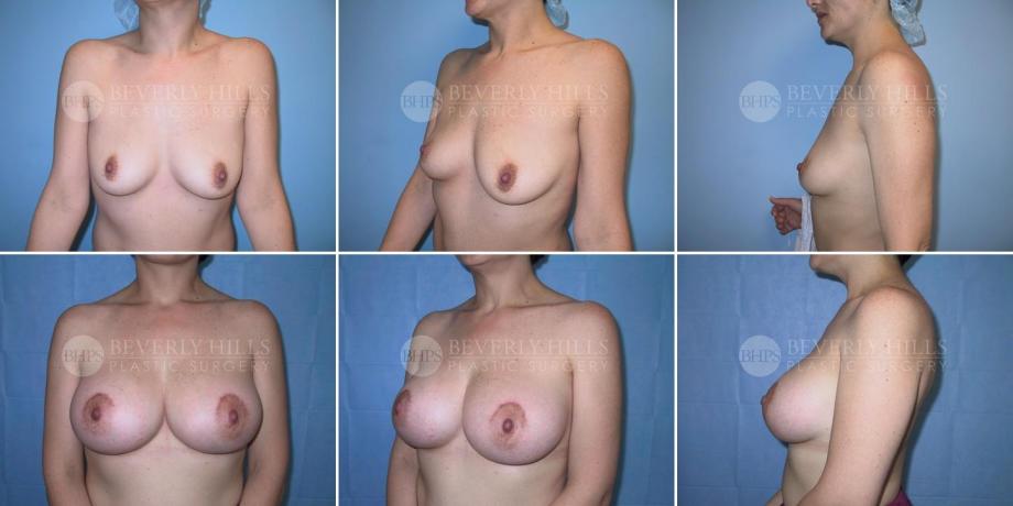 Beverly Hills Plastic Surgery gallery image 229