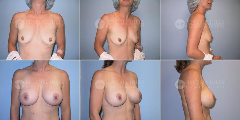 Beverly Hills Plastic Surgery gallery image 232