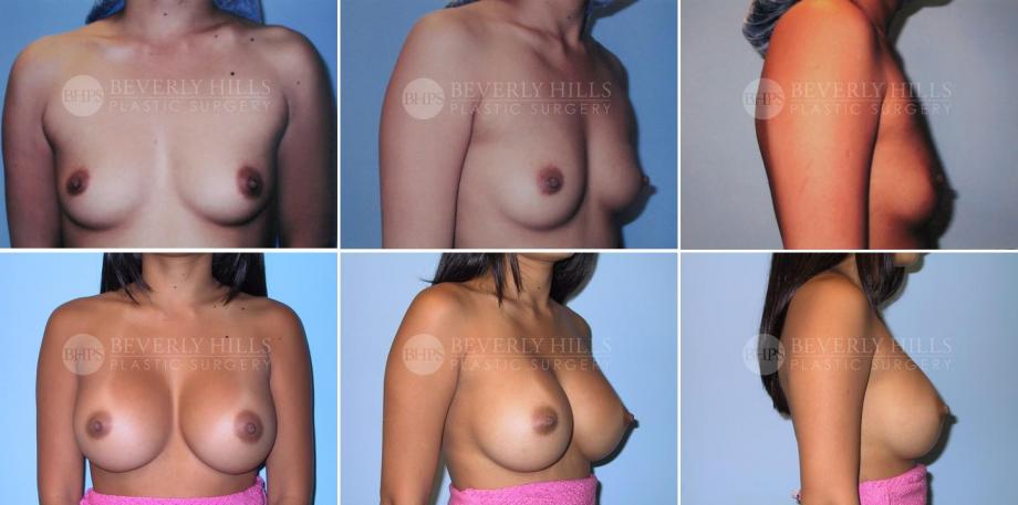 Beverly Hills Plastic Surgery gallery image 233
