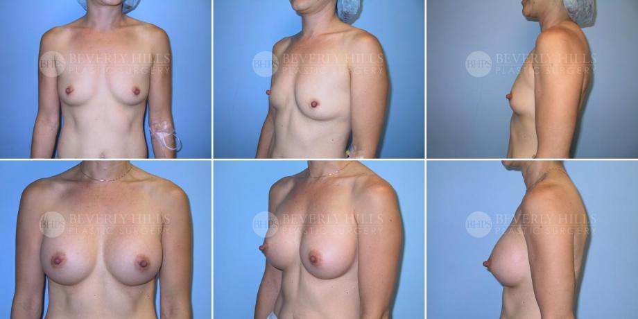 Beverly Hills Plastic Surgery gallery image 235