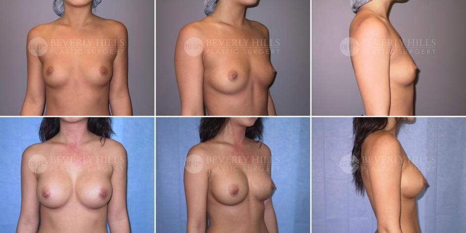 Beverly Hills Plastic Surgery gallery image 237