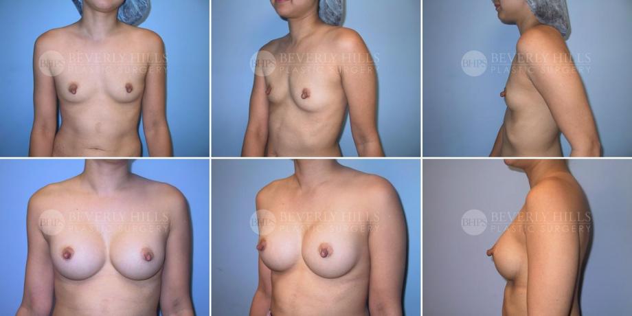 Beverly Hills Plastic Surgery gallery image 238