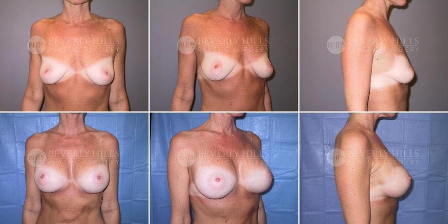 Beverly Hills Plastic Surgery gallery image 239