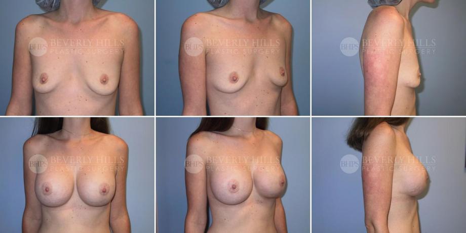 Beverly Hills Plastic Surgery gallery image 240