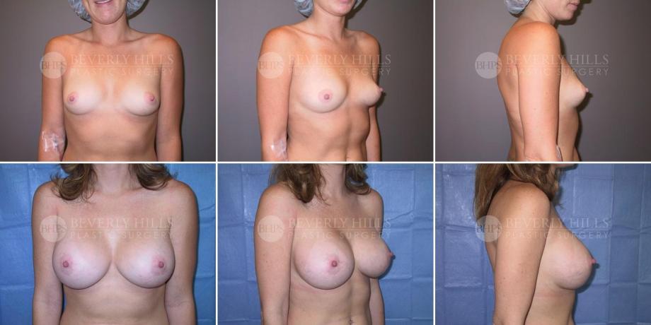 Beverly Hills Plastic Surgery gallery image 243
