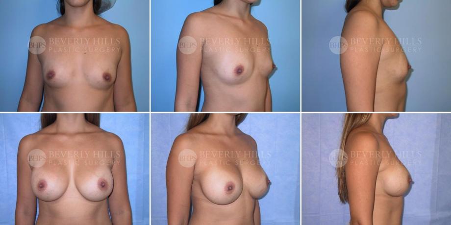 Beverly Hills Plastic Surgery gallery image 244