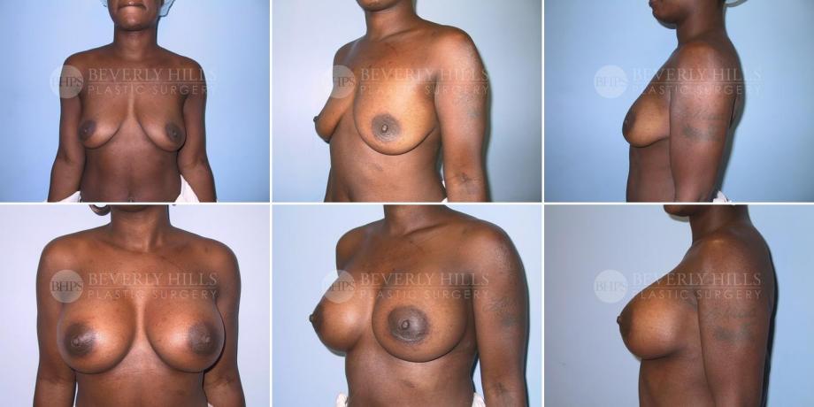 Beverly Hills Plastic Surgery gallery image 246