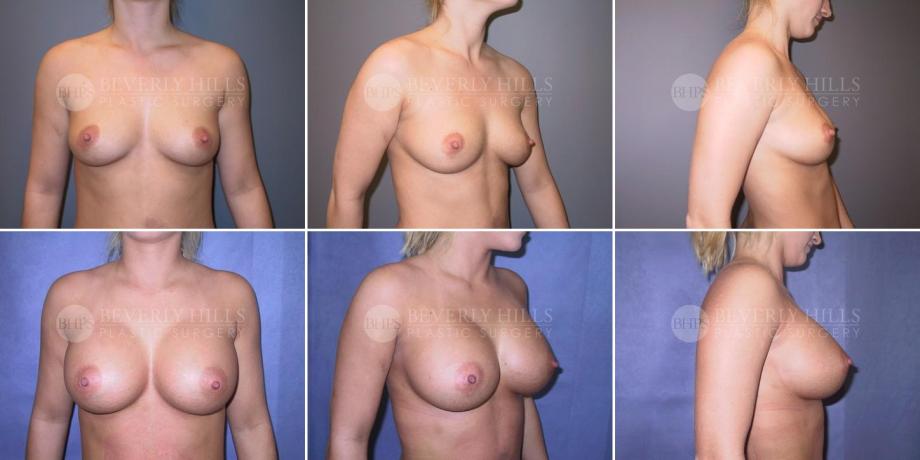 Beverly Hills Plastic Surgery gallery image 248