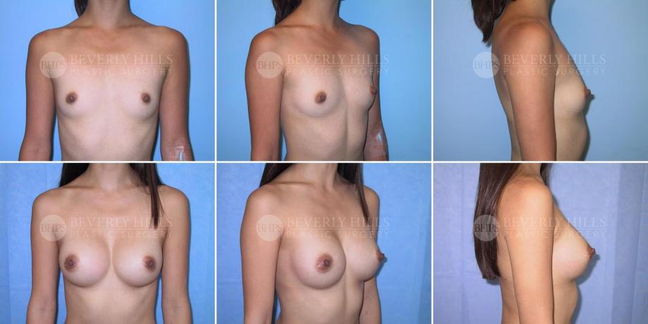 Beverly Hills Plastic Surgery gallery image 251