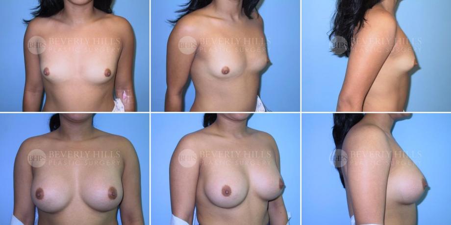 Beverly Hills Plastic Surgery gallery image 252