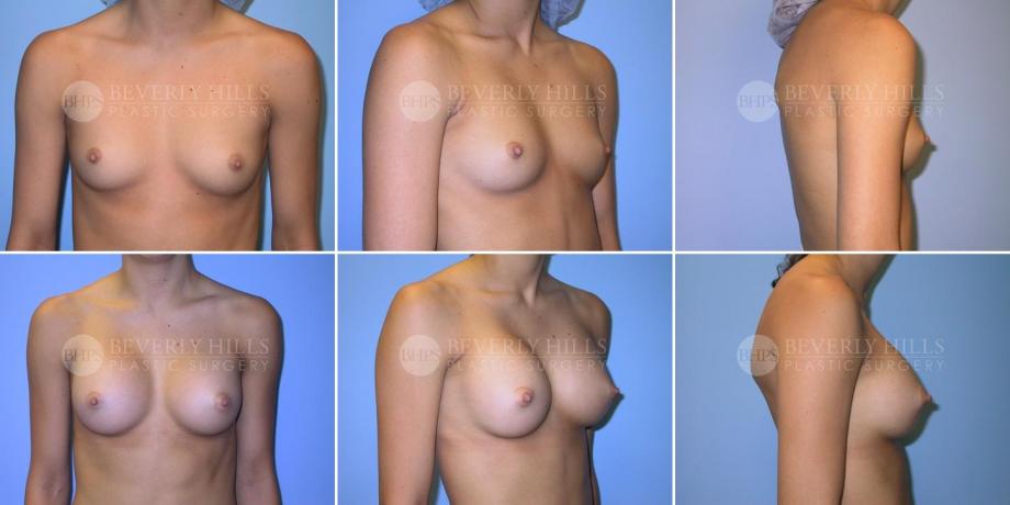 Beverly Hills Plastic Surgery gallery image 253