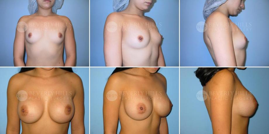 Beverly Hills Plastic Surgery gallery image 254