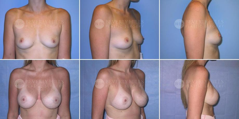 Beverly Hills Plastic Surgery gallery image 256