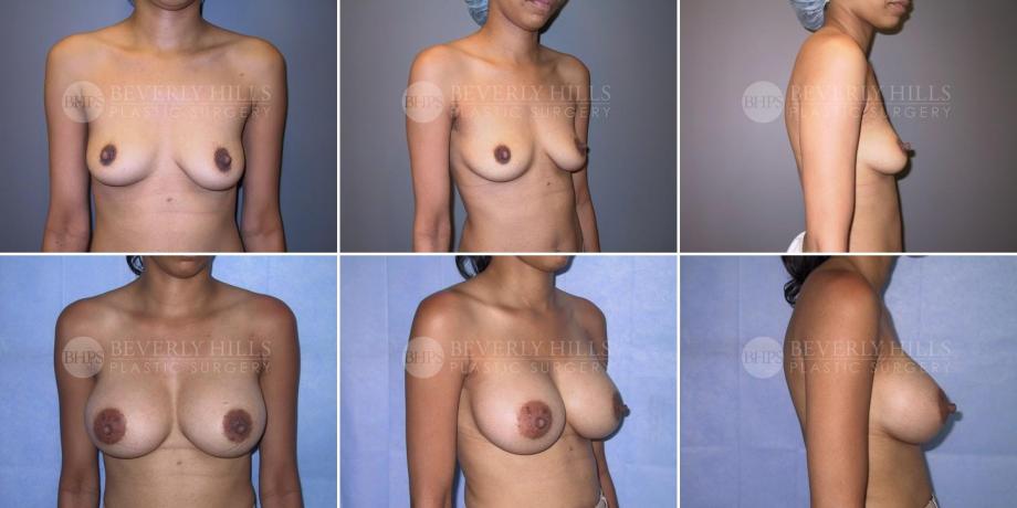 Beverly Hills Plastic Surgery gallery image 257