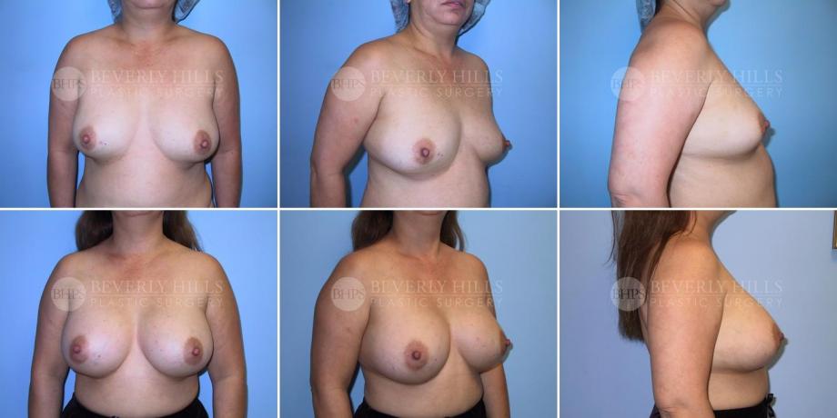Beverly Hills Plastic Surgery gallery image 259