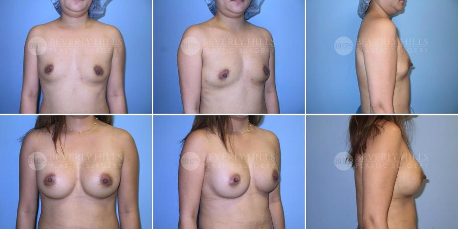 Beverly Hills Plastic Surgery gallery image 260