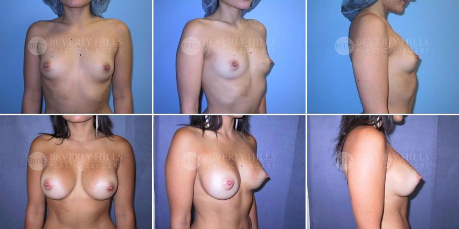 Beverly Hills Plastic Surgery gallery image 263